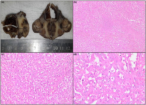 Figure 3. (a) Macroscopic image of a section from thyroid of the primary angiosarcoma case. A number of enlarged nodules are detected in different sizes, some of which are cystic formations. (b–c–d) Histopathological image of the case. Atypical cells with hyperchromatic nuclei and vascular channels containing erythrocytes are prominent (H&E, ×110, ×200, ×400).