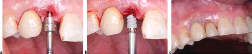 Figure 4. Case tooth #12, where implant primary stability was achieved with the mechanical handpiece only. Atraumatic extraction (a), implant placement and time of primary stability (b and c).