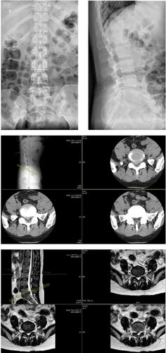 Figure 3 Preoperative X-ray positive and lateral radiographs showed lumbar degeneration. Preoperative CT and MRI showed L5/S1 disc herniation and spinal stenosis.