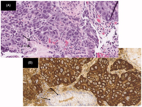 Figure 4. (A) Histopathology of hepatoid carcinoma in the gastric mucosal primary lesion The tumour comprised a mixture of pseudoglandular and hepatoid components. Note the normal glandular structure (arrows) (haematoxylin and eosin staining; original magnification, ×400). (B) Immunohistochemical staining showing intracytoplasmic positivity for AFP (dark brown). Note the non-staining normal glandular structure (arrows) (original magnification, x400).