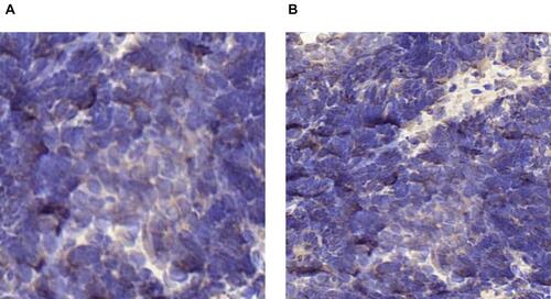 Figure 4 (A and B) IHC of PD-L1-positive expression in tumor biopsy specimens (brown). (A) Before anlotinib therapy, TPS < 1%; (B) after anlotinib therapy, TPS ≥1%.