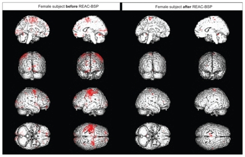 Figure 2 Functional magnetic resonance imaging of a female subject.