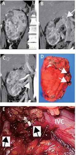 Figure 1 Computed tomography (CT) findings (A–C), resected specimen (D), and intraoperative laparoscopic findings (E) in Patient 1.