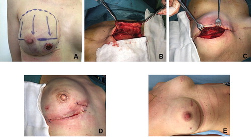 FIGURE 1. Photo documentation of the surgical intervention. A: A patient selected for capsuloplasty. B: The dissected capsule flap. C: The implant after positioning and covering with the capsule flap. D: The closed wound. E: The healed wound 3 month after the operation.