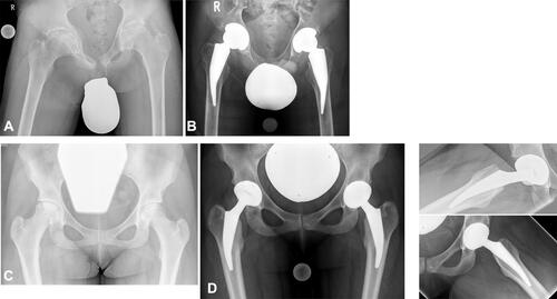 Figure 4 14-year-old boy with secondary femoral head necrosis on both sides after chemotherapy and radiotherapy for treating Hodgkin‘s disease (A). Despite the osteopenic bone situation, Metha® prostheses were performed due to the young age (B). 16-year-old girl with secondary femoral head necrosis on both sides following Chemotherapy and long-term cortisone treatment for acute lymphatic leukemia (C). 4-year follow-up after endoprosthetic treatment with Metha® prostheses (D). Data from Ishaque B.Citation13