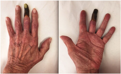 Figure 1. A dorsal and palmar view of the patient’s hand at presentation, demonstrating necrosis of the middle finger distal to the middle phalanx.