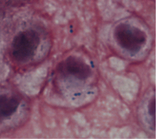 Figure 1 Spinal fluid smear for the case patient.Note: Photomicrograph of a Gram-stained spinal fluid showed gram-positive cocci (magnification; 1000x).