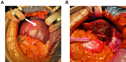 Figure 9 Intraoperative photographs during stage II surgery. (A) Ischemic line (white arrow) of the right live in stage I surgery; (B) Liver cross-section.