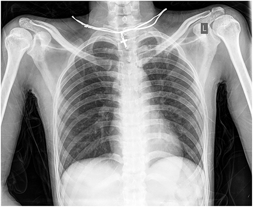 Figure 1 The patient’s chest x-ray indicated no pathology or localized consolidation.