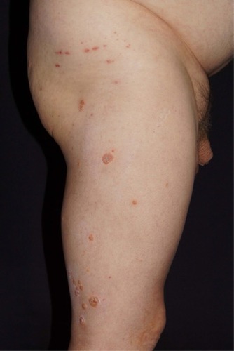 Figure 4 Generalization of herpes zoster vesicles.