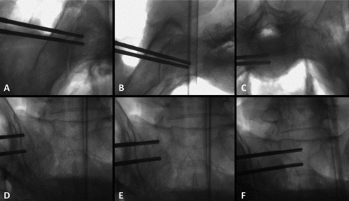 FIGURE 1  Radiographs obtained by use of a fluoroscan showing the both inserted Densiprobes at the measurement points (subcategories “superior” and “inferior”) on an inlet (A–C) or an outlet view (D–F) of the right hemipelvis at the level of the iliosacral joint (A, D), the lateral mass of the sacrum (B, E) and the center of the vertebral body of S1 (C, F).