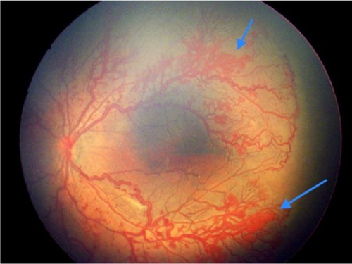 Figure 2 Left eye of a female infant born at 33 weeks weighing 1,750 g in a private rural neonatal center showing aggressive posterior retinopathy of prematurity with neovascularization in zone 1 (blue arrows), severe plus disease, and closed capillary loops.