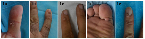 Figure 1 Clinical ADF manifestations (five patients in a, b, c, d, and e).