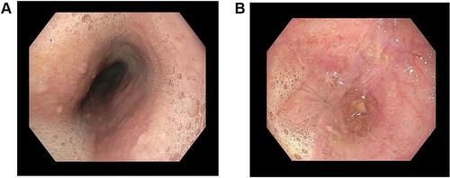 Figure 1 (A) Frothy secretion seen in mid esophagus, and (B) food debris in lower esophagus and tight GEJ.