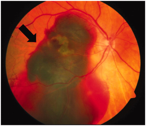 Figure 3. Neovascular age-related macular degeneration (nvAMD). In nvAMD choroidal neovascularization (CNV) due to an imbalance of pro- and anti-angiogenic factors like VEGF and PEDF leads to severe hemorrhages damaging the retinal pigment epithelium (RPE) and the neural retina. The funduscopic image illustrates such a bleeding (arrow) in advanced nvAMD (see colour version of this figure at www.tandfonline.com/ibmg).