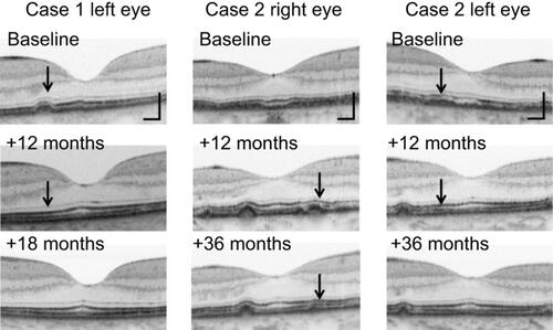 Figure 3 Horizontal SD-OCT images of the fovea from the time when the serous retinal detachment resolved to the final visit. Lesions involving elevation or thickening of the RPE layer were partly diminished (arrows).Abbreviations: RPE, retinal pigment epithelium; SD-OCT, spectral- domain optical coherence tomography.