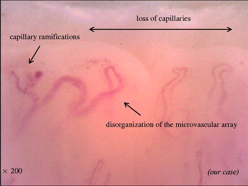 Figure 3. Representative photograph of disorganization of loss of capillaries, microvascular array, and capillary ramifications.
