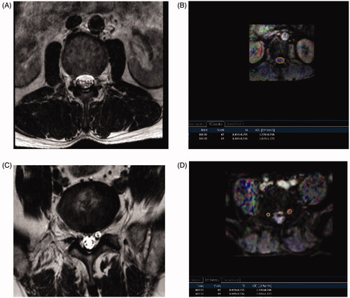 Figure 3. The cauda equina MRI T2W image (A) and its FA mapping of DTI (B). ROIs were placed on the cauda equina on the zones equally to the disc plane (superior 1/3, middle 1/3, and inferior 1/3) on the FA mapping and the FA values were calculated (B), the minimum value of three zones was taken as the cauda equina FA at that level; MRI T2W image of bilateral nerve roots (C) and FA mapping of DTI of bilateral nerve roots (D) ROIs were placed on the: ‘intraspinal’, ‘intraforaminal’, and ‘extraforaminal’ zones of bilateral nerve roots on FA mapping and the FA values were calculated (D), the minimum value of three zones was taken as the nerve root FA value; MRI, magnetic resonance imaging ; FA, fractional anisotropy; DTI, diffusion tensor imaging.