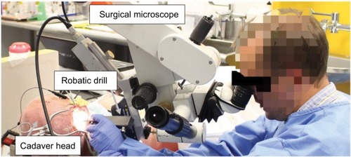 Figure 4 Drilling cochleostomy using hand-guided robotic drill on cadaver.