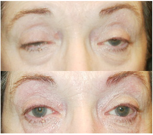 Figure 3 The ice test is unequivocally positive in this patient, presenting with progressive ptosis worsening with fatigue (above). Significant improvement is noticed after placing ice packs for 2 minutes over the eyelids (below).