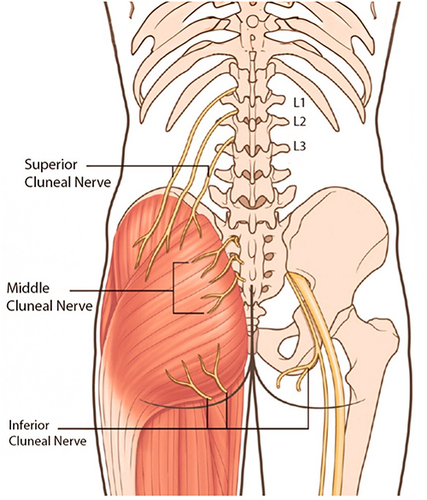 Figure 1 Superior, middle, and inferior cluneal nerves. Superior cluneal nerves as they cross over the iliac crest. (Image created by Michael Gyorfi).
