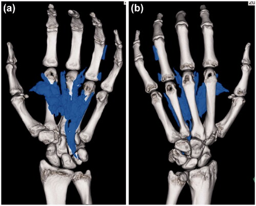 Figure 4. Computed tomography images acquired after the first operation show paint in the thenar space and the index, middle, and ring fingers.