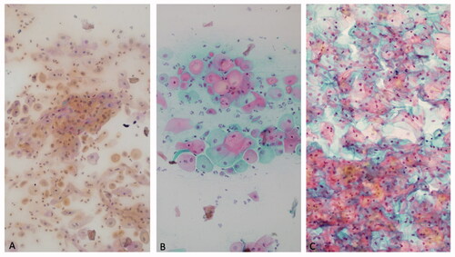 Figure 1. Cytological appearance of vaginal smear. Low vaginal maturation index (A); 50–64 moderate vaginal maturation index (B); high vaginal maturation index (C).