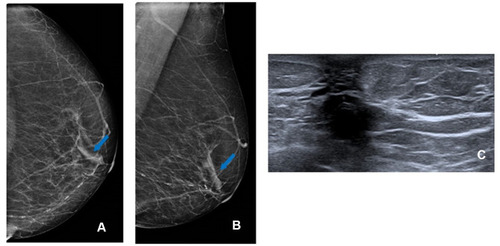 Figure 1 False-positive mammography. Solitary dilated duct (blue arrow) at left cranio-caudal (CC) mammogram view (A) and at medio-lateral oblique (MLO) mammogram view (B); ultrasound (US) shows no findings at retro-areolar area (C).