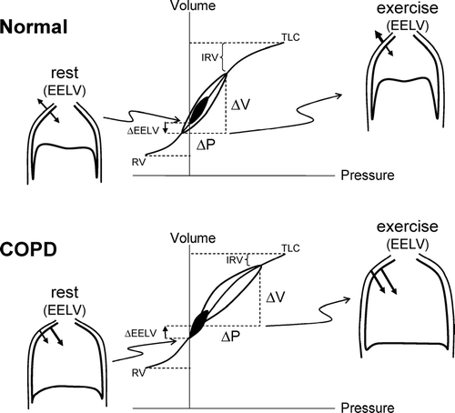 Figure 2 Pressure-volume (P-V) relationships of the total respiratory system in health and in COPD. Tidal pressure-volume curves during rest (filled area) and exercise (open area) are shown. In COPD, because of resting and dynamic hyperinflation (a further increased EELV), exercise tidal volume (VT) encroaches on the upper, alinear extreme of the respiratory system's P-V curve where there is increased elastic loading. In COPD, the ability to further expand VT is reduced, i.e., inspiratory reserve volume (IRV) is diminished. In contrast to health, the combined recoil pressure of the lungs and chest wall in hyperinflated patients with COPD is inwardly directed during both rest and exercise; this results in an inspiratory threshold load on the inspiratory muscles. Abbreviations: EELV = end-expiratory lung volume; RV = residual volume; TLC = total lung capacity. Reprinted from Mahler DA, O'Donnell DE (eds). Dyspnea: Mechanisms, Measurement, and Management, 2nd edition. Lung Biology in Health and Disease Series, Volume 208, Chapter 3. New York: Taylor & Francis Group, 2005; pp. 29–58, used with permission.