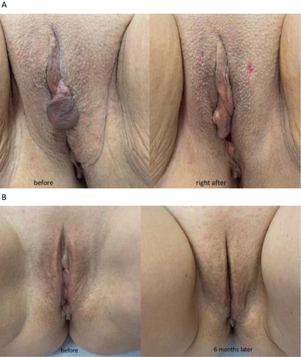 Figure 9 (A) Before and right after threads implantation from the pubic entry point. (B) Before and after 6 months after threads implantation.
