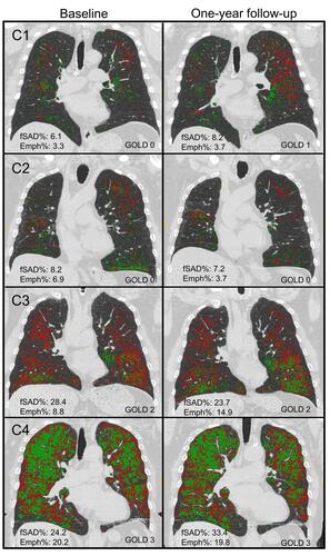 Figure 5 Baseline (left column) and one-year follow-up (right column) fSAD (red) and emphysematous regions (green) of cluster-representative subjects. (C1, C2, C3, and C4) refer to cluster 1, cluster 2, cluster 3, and cluster 4, respectively.