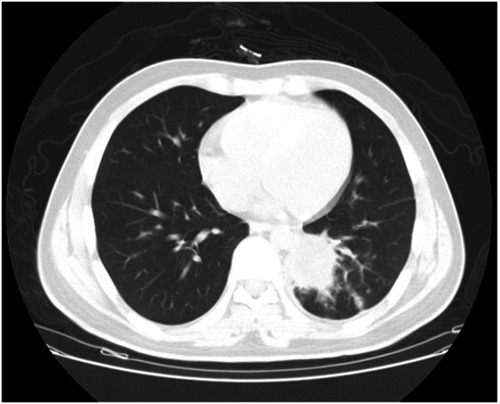 Figure 1 Aspergilloma on chest computed tomography (Patient 2). The lesion is visible as a cavitation within normal lung tissue in the left lower lobe.