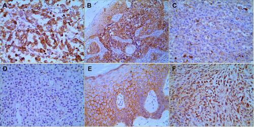 Figure 1 Immunohistochemical staining of CM and control tissue. In the CM tissue, positive VEGF expression (A), positive β-catenin expression in the cytoplasm and nuclei (B), and negative DKK1 expression (C) were displayed. In the control tissue, negative VEGF expression (D), positive β-catenin expression in the cell membrane (E), and positive DKK1 expression (F) were displayed. Positive cells exhibited brown cytoplasmic staining (at 400 × magnification).