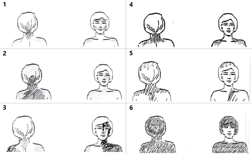 Figure 3 Drawings from study participants. To the left (1–3) are examples where C2 involvement was assessed to be present. To the right (5–6) are drawings with examples of a negative outcome. (1) Criterion A is met (upper neck) and 3 of criteria B (pain involving back of head, both jaws and left temple). (2) Criterion A is met and 1 of criteria B: back of head. (3) Criterion A is met and 2 of criteria B: ear and jaw. (4) Criterion A is met, not B. (5) Criterion A is met, not B. (6) Neither A or B is met (homogenous shading, ie, no pain punctum maximum in C2 supplied areas).