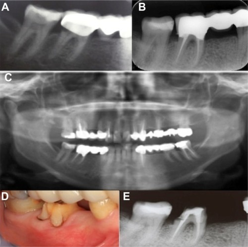 Figure 1 (A) Preoperative radiograph of tooth #46. (B) Postoperative radiograph following root canal treatment. (C) Panaromic radiography following bridge restoration. (D and E) Intraoral appearance and periapical radiograph at 1-year recall.