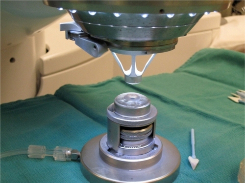 Figure 1 The setup for applanation of donor cornea with an artificial anterior chamber system and femtosecond laser cone.