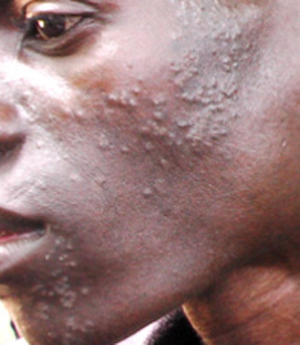 Figure 3.  An HIV+ man who asked to have his skin rash photographed, so that people will know the symptoms of his disease.