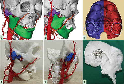 Figure 4. Digital design and fabrication of simulation model for reconstructive surgery. (a,b) the close relationship between the tumor and blood vessels; (c) image registration technique and inverse design for restoring the anatomical shape of the destruted fossa [Citation8]; (d,e) 3D printing model displaying the exact location of the tumor and the nature of its relationship with the peripheral blood vessels, nerves, and other tissues; (f) placement of titanium mesh preoperatively.