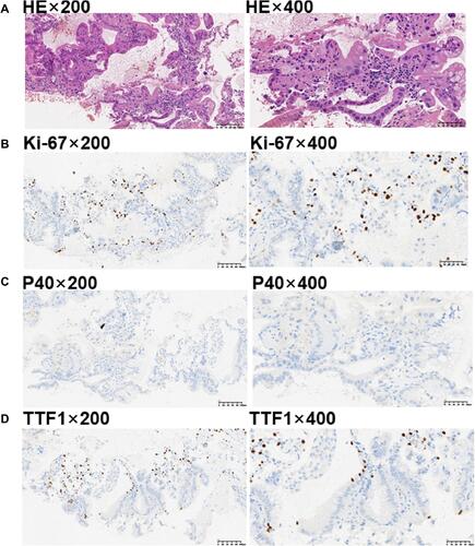 Figure 2 Pathological analysis of percutaneous lung biopsy. (A) HE staining confirmed typical lung adenocarcinoma morphology, immunohistochemistry showed that (B) Ki-67 was approximately 5% positive, (C) P40 negative, and (D) TTF-1 focally positive.