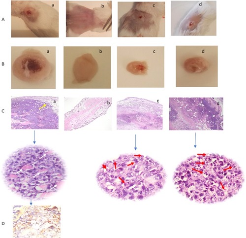 Figure 6 (A) Tumor-bearing mice. (B) Excised tumors. (C) H&E histopathological examination of tumor tissue sections at the end of study period using two magnification powers ×200 and 400 original magnification. (D) Immunohistochemical staining of tumor tissue shows focal and strong positive staining of the malignant cells to Multi-Cytokeratin AE1/AE3 (Ready to use primary antibody, Mouse anti-human, monoclonal antibody, P0012, Bond-Max fully automated immunostainer, Leica Biosystems, USA). For the following groups, (a) untreated (positive control) tumor infiltrating the dermis, subcutaneous, and muscular tissues (yellow arrow). The tumor is formed of masses of malignant cells with pleomorphism, hyperchromatism, vesicular nuclei, and prominent nucleoli with frequent tumor giant cells (white arrow), (b) Normal (Negative control), (c) ETD Nanoformulation treated (red arrows point to apoptotic cells and apoptotic debris), and (d) ETD solution treated (red arrows point to apoptotic cells and apoptotic debris).Abbreviations: H&E, hematoxylin and eosin; ETD, etodolac.