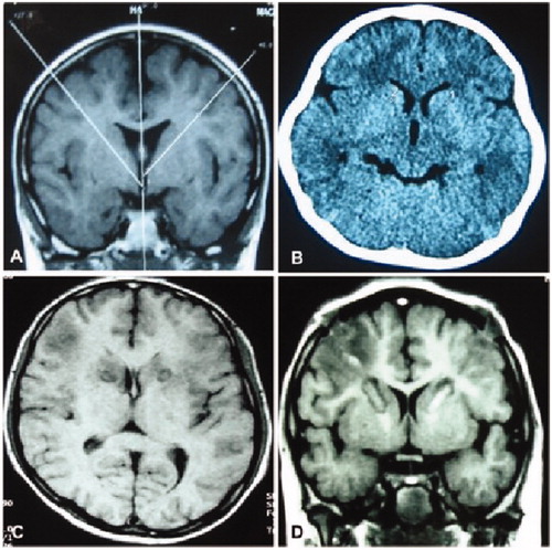 Figure 2. Radiofrequency thermocoagulation in the anterior limbs of internal capsule. (A) The angle of anterior limbs of the internal capsule was shown for location of thermocoagulation. (B) Radiofrequency thermocoagulation was performed in the anterior limbs of internal capsule. (C&D) Eight days after the thermocoagulation, the thermocoagulation lesions were shown in the anterior limbs of the internal capsules.