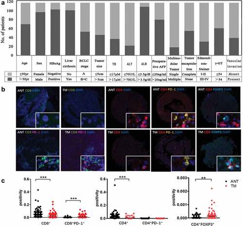 Figure 1. Summary of clinical information and tumor immune microenvironment. (a) We developed tissue array of 117 HCC patients and summarized clinical characteristics. Each patient has more than 5-year follow-up. (b) Opal multicolor IHC staining with anti-CD8, anti-CD4, anti-PD-1, FOXP3 antibodies, and DAPI. (c) Comparison of CD8+, CD8+PD-1+, CD4+, CD4+PD-1+ and CD4+FOXP3+ expression between ANT and TM