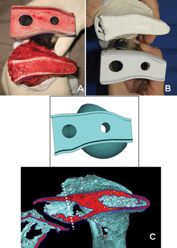 Figure 4. The cut surface of the ilium after pelvic resection under navigational guidance (A); after preoperative simulation of the pelvic resection in the plaster model (B); and at the predetermined level of pelvic resection on CAD data (C). [Color version available online.]