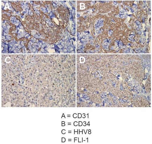 Figure 1 Immunohistology: immunohistochemical stainings for CD31 (A), CD34 (B), HHV8 (C), and D2-40 (D) of the chest tumor (immunoperoxidase, original magnification: A-C 40×, D 20×).