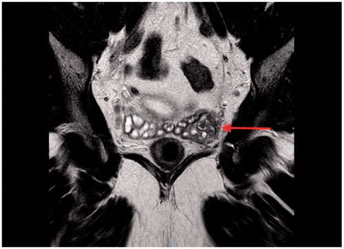 Figure 1. A case of persistent haematospermia secondary to seminal vesicle calculi in an ageing male.