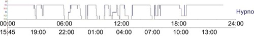 Figure 1 Typical 24h-hypno of a cirrhotic patient, showing four naps over day and a disturbed sleep with several wake periods after sleep onset.