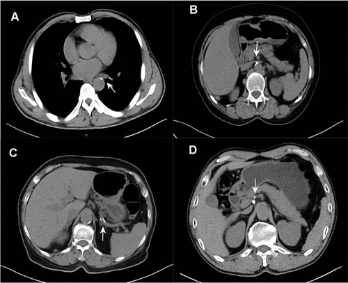 Figure 2 Examples of calcification on preoperative CT images in patients with gastric cancer. (A) Image showing the descending aorta with a plaque and calcified foci (arrow). (B) Image showing calcification of the celiac axis (arrow). (C) Image showing calcification of the splenic artery (arrow). (D) Image showing calcification of the common hepatic artery (arrow). A calcification score of 1 was assigned to the above four images.