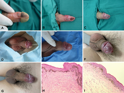 Figure 2 Flap design and flowchart of Case 8. (A) Preoperative divided nevus position. (B) Lesion site excision extension. (C) Immediate outcome after surgery. (D) The penis and glans position first day after surgery. (E) The penis and glans position 3rd day after surgery. (F) The penis and glans position about 1 month after surgery (Because of local tissue edema, the suture removal time was prolonged). (G) The penis and glans position about 6 months after surgery. (H and I), (H) Glans position, (I) Inner prepuce plate position. For the histopathology, HE staining indicated compound nevus under a magnification of 100×. Nevus cell nests at the dermo-epidermal junction and lower dermis.
