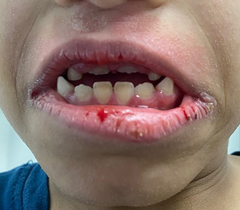 Figure 2 Dry lips with fissures and angular cheilitis.