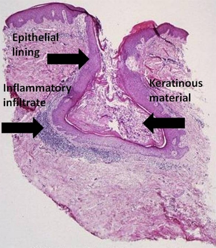 Figure 3 Acne vulgaris, comedone. (Cx7).Source: Graham Library of Digital Images, Wake Forest University Department of Dermatology. © 2009 Wake Forest University Dermatology.